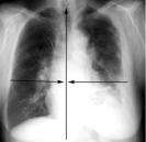 mesothelioma xray